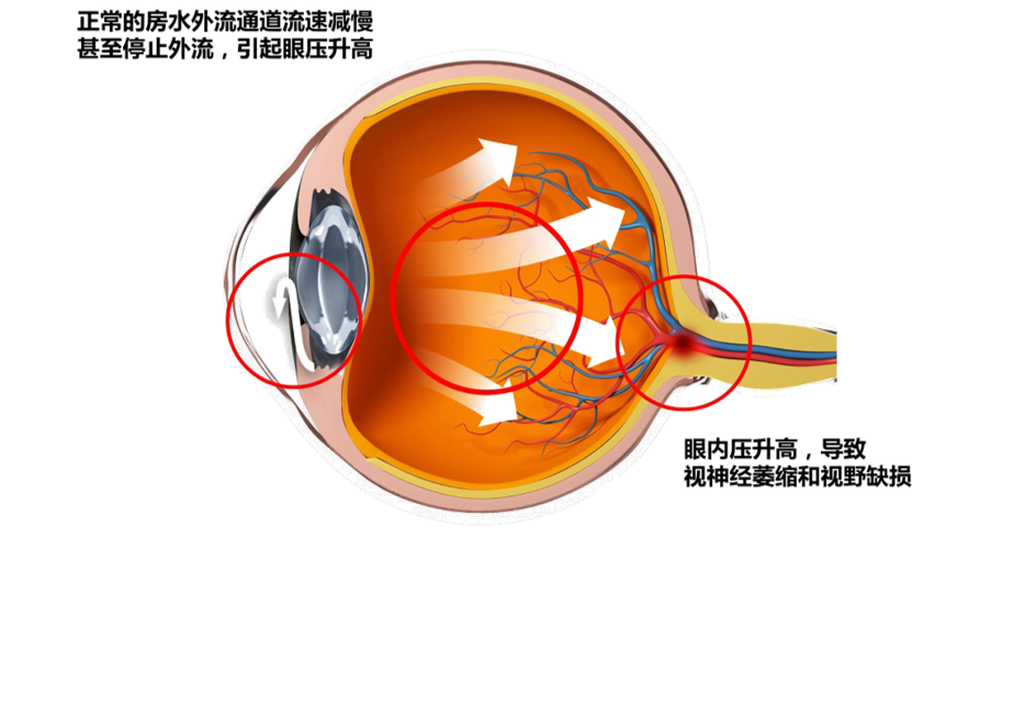 并非老年人专属，年轻人也须提防青光眼